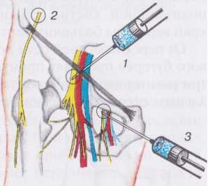 Блокада бедренного нерва Блокада бедренного нерва